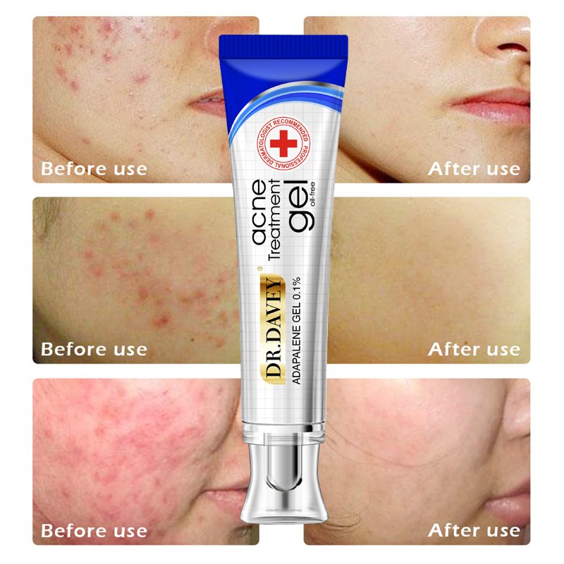 DR. DAVEY Acne Treatment Gel Oil Free Cream 1 DR. DAVEY Anti Acne Treatment Gel Oil Free Cream Price in Bangladesh