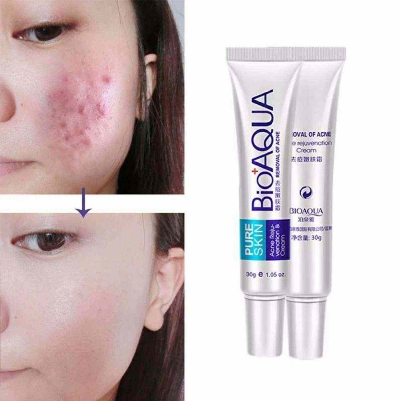 Bioaqua Skin Care Acne Treatment Remove Pimples Face Acne Scars 1 Bioaqua Skin Care Acne Treatment Remove Pimples Face Acne Scars
